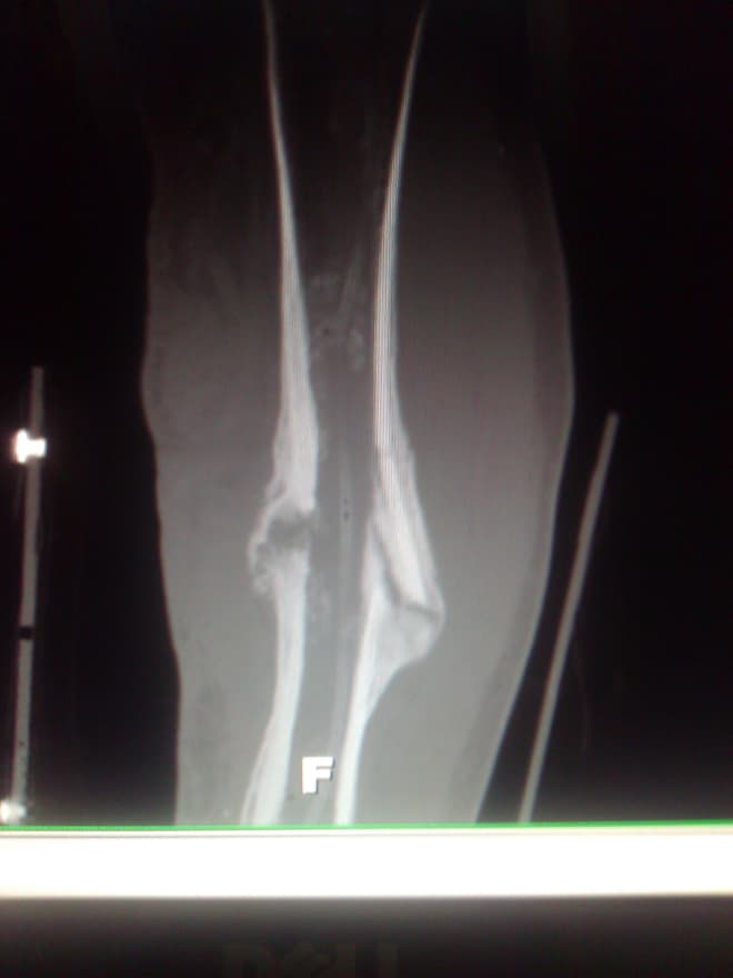 X-Rays of Adam Ploudre's leg after the injury 